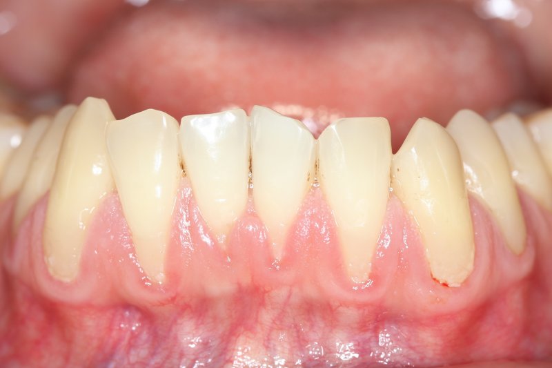 Gums that have receded due to gum disease