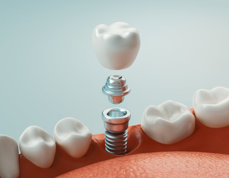 3-D diagram of a dental implant 