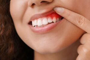 Woman checking her gums