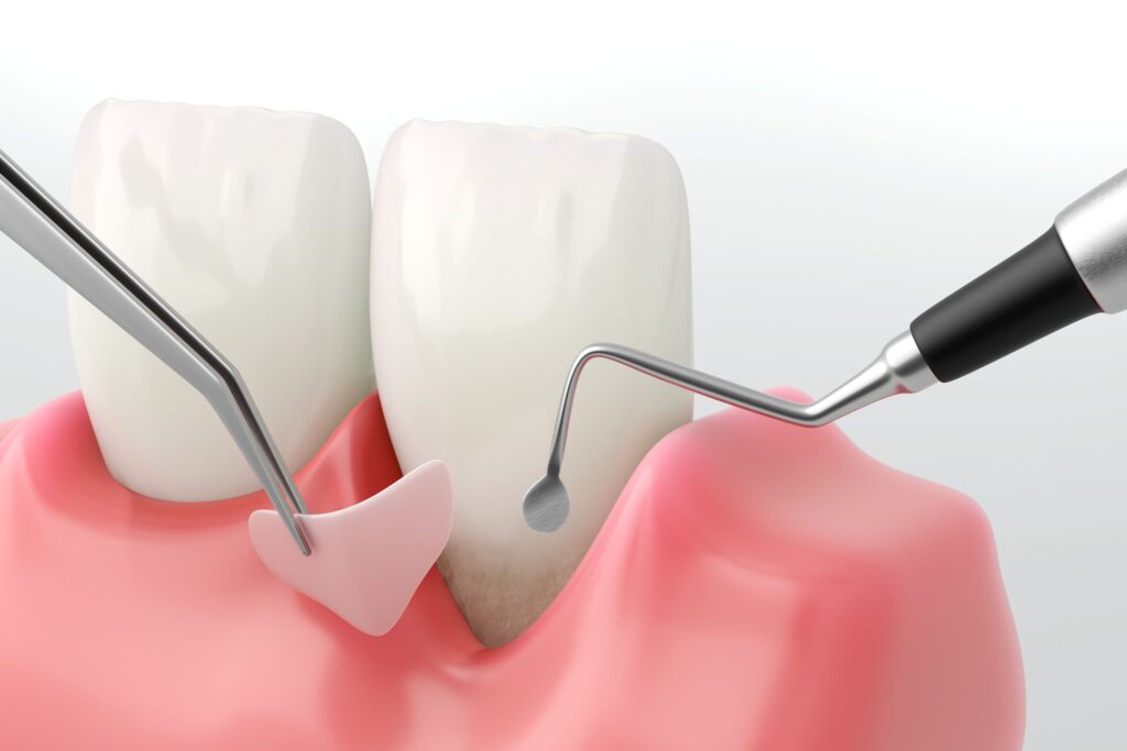 Rendering of dental instruments placing gum graft over root of tooth