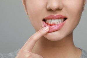 Woman pulling down lip to reveal red gums. 